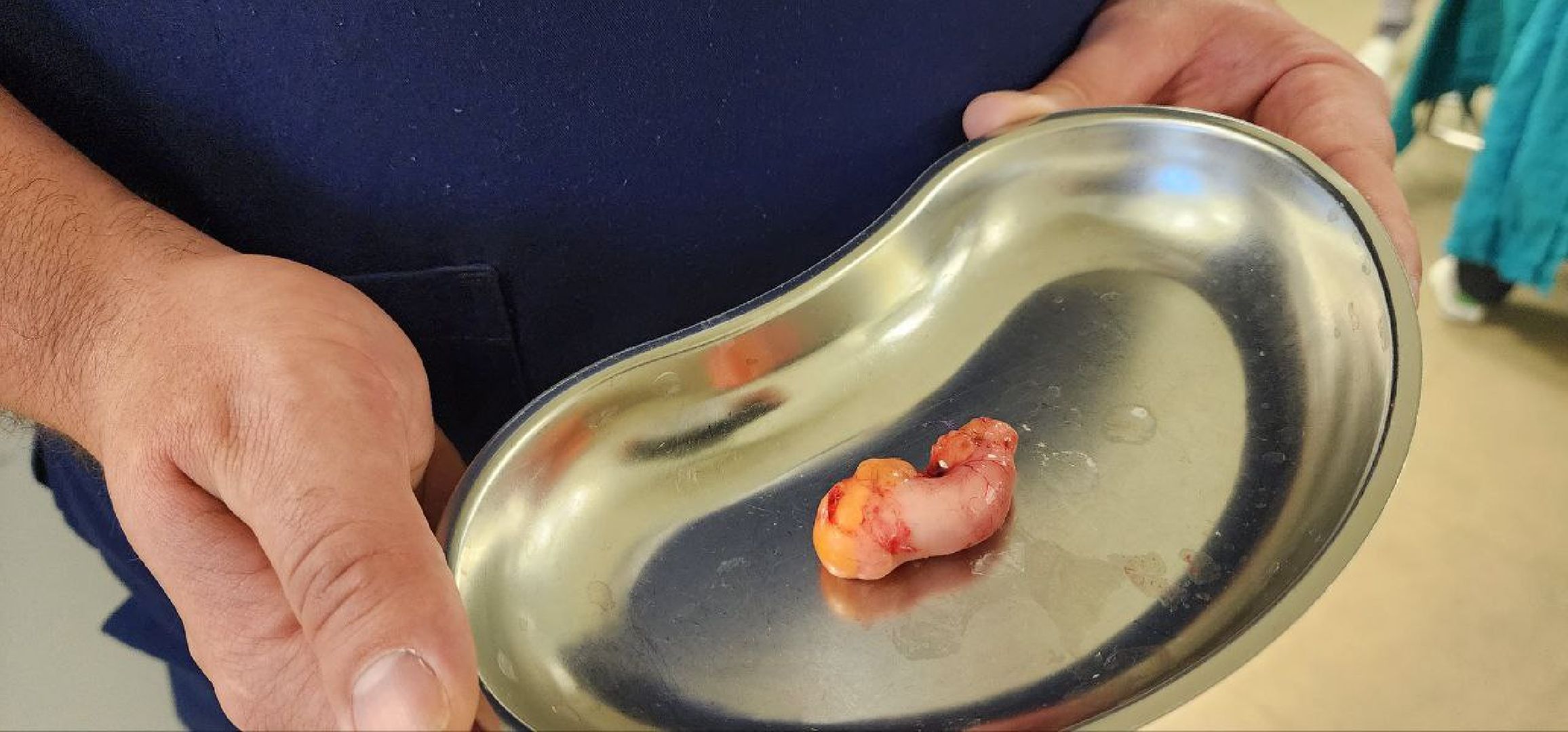 Дмитров, Дмитровская больница, Малоинвазивные операции, Лапароскопическая методика лечения, Минздрав,