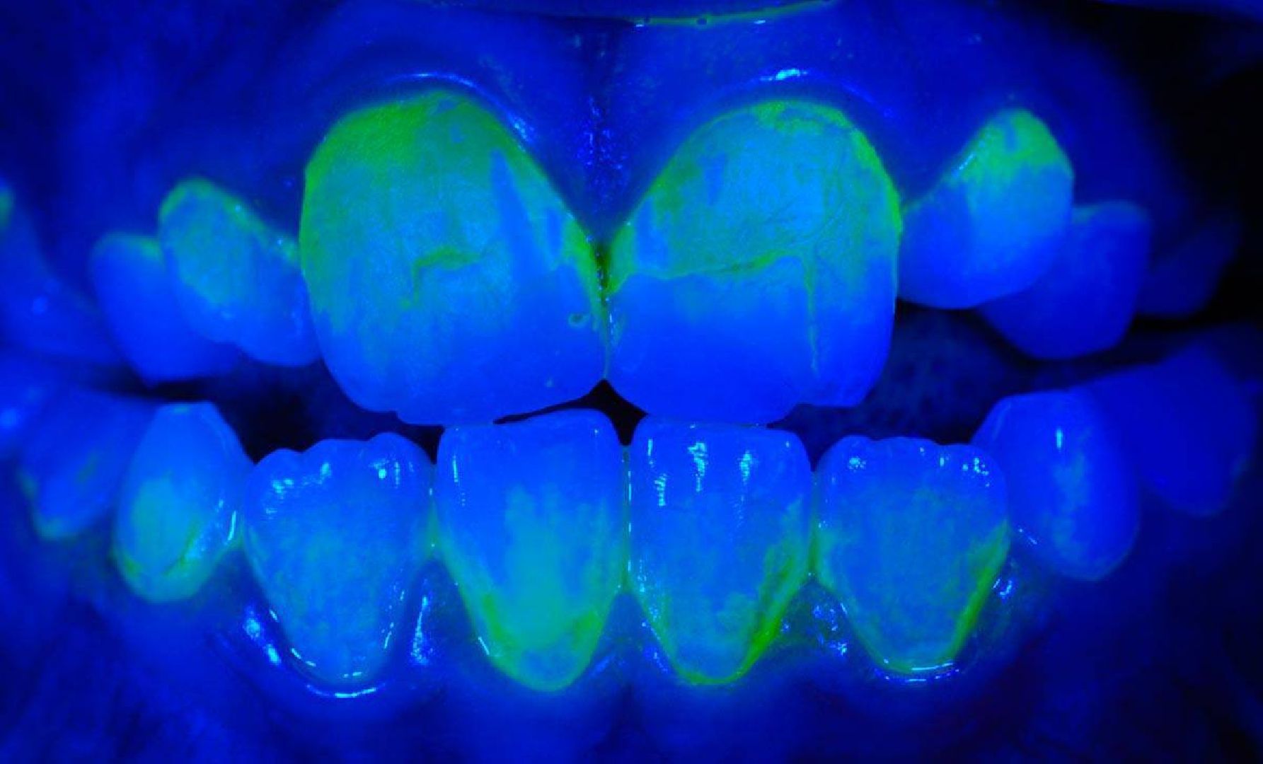 Люберцы, люберецкая областная больница, онкоскрининг полости рта,