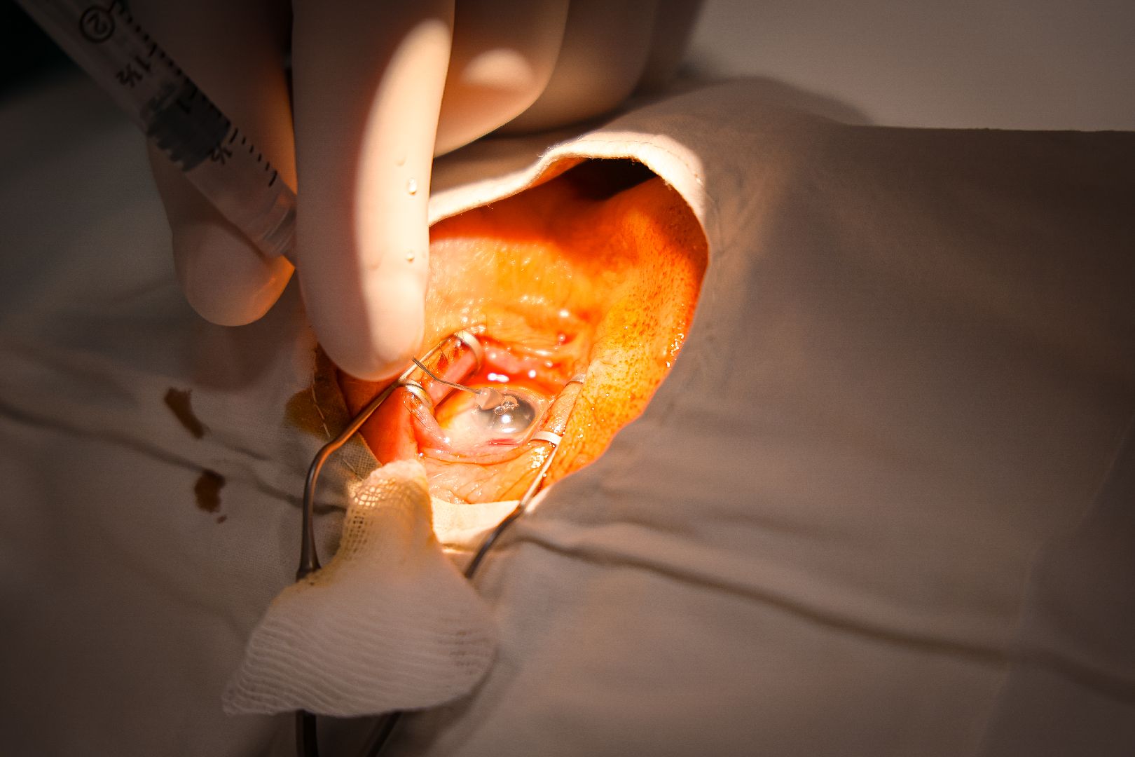 клин, общество, медицина, редкие операции, подмосковье, врачи,