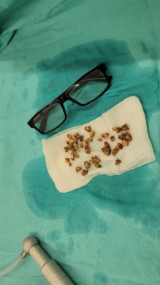 раменское, медицина, раменская больница, малоинвазивные операции в урологии, профилактика и лечение мочекаменной болезни ,