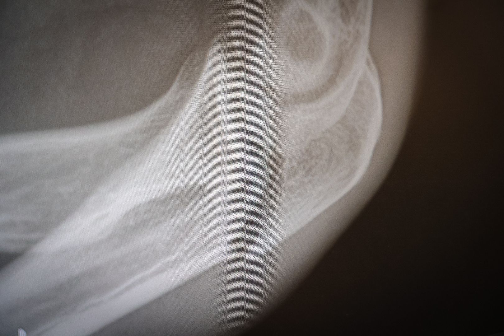 клин, общество, медицина, переломы, гололед, люди,