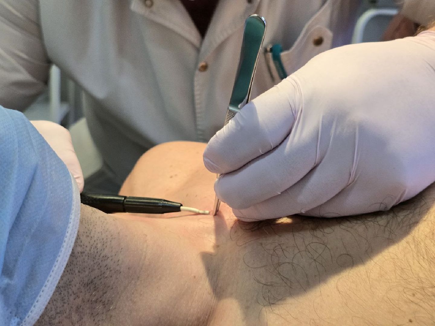 можайск, можайский муниципальный округ, подмосковье, можайская больница, медицина, здравоохранение , хирургическое отделение, новообразования кожи ,